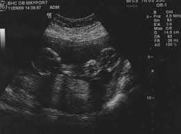 As well as the pregnancy symptoms being more severe, they can also occur much earlier on. Ultrasound 6 Weeks Pregnant With Twins Novocom Top