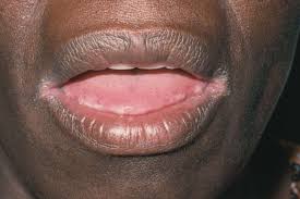 Image result for Angular Stomatitis