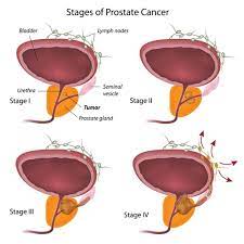 However, as with other types of cancer,. Prostate Cancer Stages