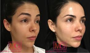 He is an ivy league trained surgeon who comes from manhattan to bring the latest cosmetic expertise. Non Surgical Brow Lift Botox Juvederm