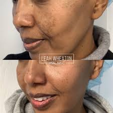 Melasma (“pregnancy mask”) treated here with full face Erbium laser  resurfacing and hydroquinone application 1mo ago. This patient has followed  a strict skin care regimen/ sun protection & avoidance and we are
