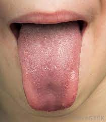 What Are The Signs Of A Tetracycline Allergy With Pictures