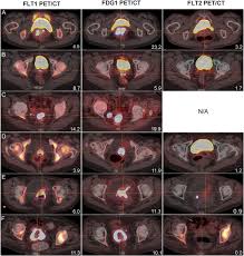 Pilot Study Assessing 18f Fluorothymidine Pet Ct In Cervical And Vaginal Cancers Before And After External Beam Radiation Sciencedirect