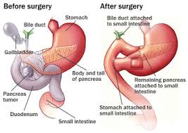 Some of the common symptoms may include: The Pancreas General Surgery Gold Coast