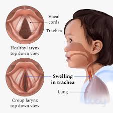Image result for Croup