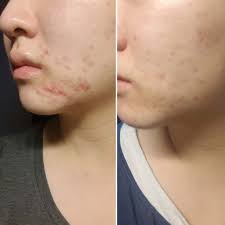 How long did you have purging after starting? I Tried Curology For 7 Months For My Acne A Review Beauty Within
