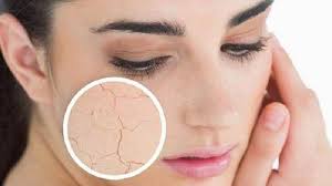 Ilansir dari miss kyra, berikut tips untuk merawat kulit kering saat cuaca dingin: Lakukan 6 Tips Ini Untuk Mengatasi Kulit Kering Saat Cuaca Dingin Tribunshopping Com