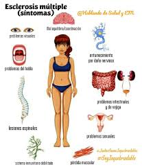 Síntomas de esclerosis múltiple · síntomas musculares: Te Comparto Los Sintomas Mas Salud Y Esclerosis Multiple Facebook