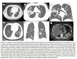 A culpa são de pequenos coágulos que o vírus cria. Jornal Brasileiro De Pneumologia Apresentacao Tomografica Da Infeccao Pulmonar Na Covid 19 Experiencia Brasileira Inicial
