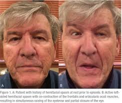Managing Eyelid and Facial Spasms