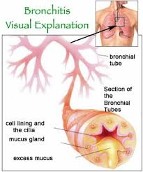 Penyebab Penyakit Bronkitis Kronis