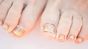 Image result for Pitting nails feet