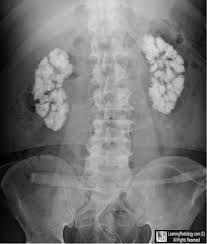 Welcome To Learningradiology Radiology Imaging Radiology Renal