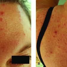 As in the previous time this disease was very common among children but now after the vaccine against chicken pox. Prenatal Ultrasound Showing Limb Deformities At The 34th Week Of Download Scientific Diagram