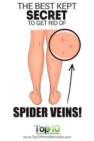 How To Get Rid Of Spider Veins Top 10 Home Remedies Spider Veins Varicose Vein Remedy Get Rid Of Spider Veins