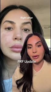 #greenscreen my experience and healing time after getting PRF @SkinScience  Med Spa #prf