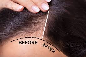 Image result for Hair Pull Test