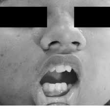 Increase in mouth opening