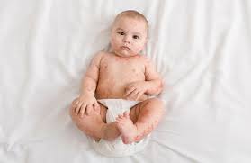Sarpullidos En Bebes Como Combatirlos Mejor Con Salud