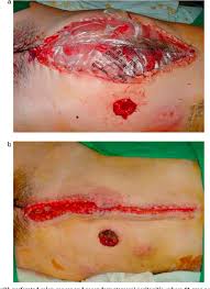 Bogota bags were used in a total of 38 patients, comprising 23 (60.5%) males and 15 (39.5%) females, with a mean age of 58.94±17.89 years. Figure 1 From Contained Laparostomy With A Bogota Bag Results Of Case Series Semantic Scholar