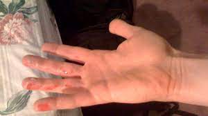 Try to keep your skin under the water for around 20 minutes or more. Rug Burn Scar On Back Picture Infected And More