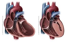 Image result for Cardiomyopathy