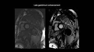 Myocarditides) is a general term referring to inflammation of the myocardium. How To Assess Myocarditis With The Help Of Cardiac Mri Cmr Youtube