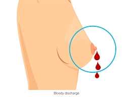 Breast cancer is a cancer which starts in the mammary glands. Breast Cancer Signs Symptoms Stages Treatment About Risk Factors Ashray