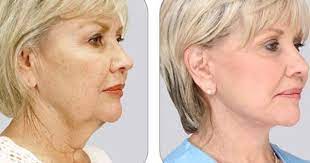 Pin On Tighten Skin