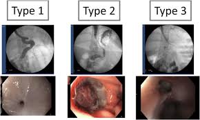 Fistulas can form between various parts of the body, including between the uterus and the peritoneal cavity (metroperitoneal, or uteroperitoneal. Radiological And Endoscopical Features Of The Three Types Of Fistula Download Scientific Diagram