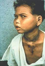 How is pellagra diagnosed and treated. Pellagra Lexikon Der Ernahrung