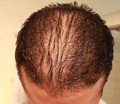| find, read and cite all the research you need on researchgate. Diffuse Hair Loss Treatment In Surat Majura Gate By Rejuvine The Hair Clinic Id 9974548955