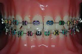 Stainless Steel Braces Colours Teeth Braces Ideas Braces Colors Rainbow Braces Getting Braces
