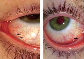 Image result for Viral Conjunctivitis