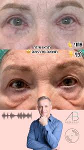 הפעם; למה לעבור ניתוחי עפעפיים דווקא אצל אוקולופלסטיקאים? התשובה