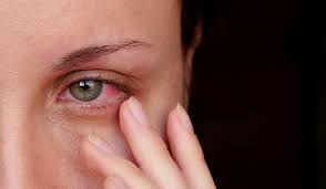 Derrame Ocular Causas Sintomas Y Tratamiento