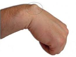 Learn vocabulary, terms and more with flashcards, games and other study tools. Chist Sinovial Chist Sinovial Ortopedie Arcalife