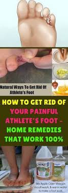 How To Get Rid Of Your Painful Athlete S Foot Home Remedies That Work 100 Homeremedies Naturalr Athletes Foot Remedies Foot Remedies Foot Fungus Remedies