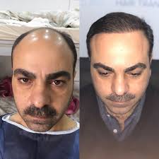 6 Ay Sonraki Degisim بشتى عه مليات ب ٦ هه يفا بعد ٦ أشهر من العملية Portrait Tattoo Portrait Tattoos