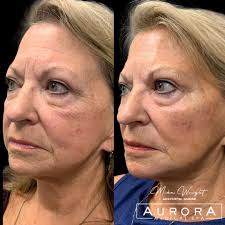 Mika Wright, BSN RN (@mika_aesthetic_nurse_injector) · Cape Girardeau, MO