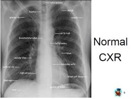 Image result for Chest XRay Interpretation