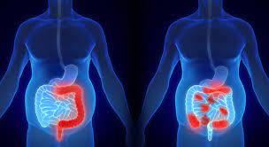 Watch a video to get the facts about who gets crohn's. Oral Manifestations Of Crohn S Disease Dimensions Of Dental Hygiene