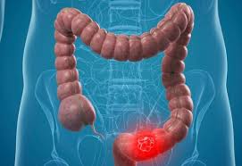 Modificările genetice în mai multe clase de gene sunt asociate cu cancerul de col uterin. Cancerul Colorectal Dr Mihai HriÅ£cu