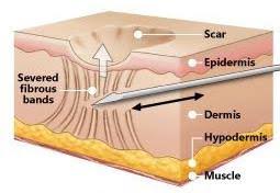 Mobility in my joints became better, and they stopped aching. Subcision For Acne Scars Expert S Guide To Effective Acne Scar Treatment In Singapore