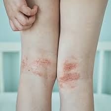 Image result for Atopic Dermatitis