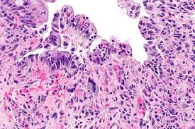 Image result for Radiation Colitis