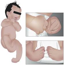 Image result for Floppy Infant