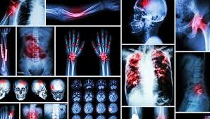 Pregnancy symptoms week 1 in tamil. à®Žà®² à®® à®ª à®ª à®ª à®± à®± à®¨ à®¯ Bone Cancer