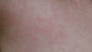 2 is roseola contagious to adults?roseola infantum is a viral illness that mostly affects infants and toddlers. Roseola Symptoms Causes And Treatment