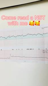 Image result for Non-Stress Test